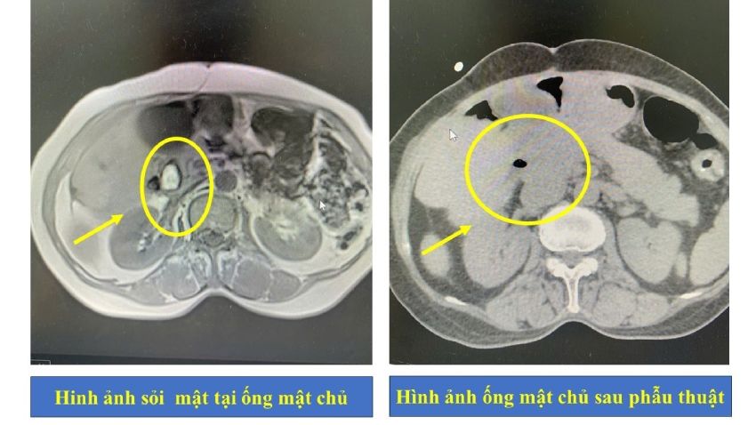 Hy hữu: Người bệnh cùng lúc bị sỏi mật gây tắc ống mật và giun trong đường mật