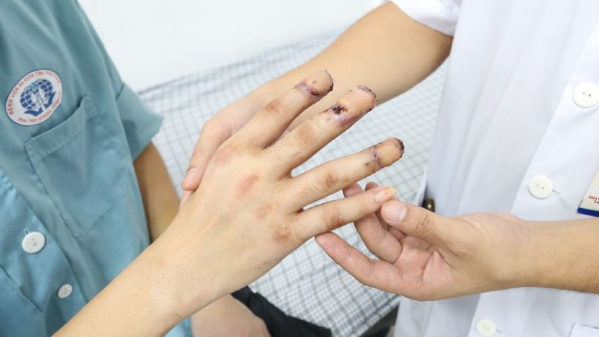 Hồi sinh bàn tay cho người bệnh có nguy cơ phải tháo khớp ngón tay do tai nạn lao động