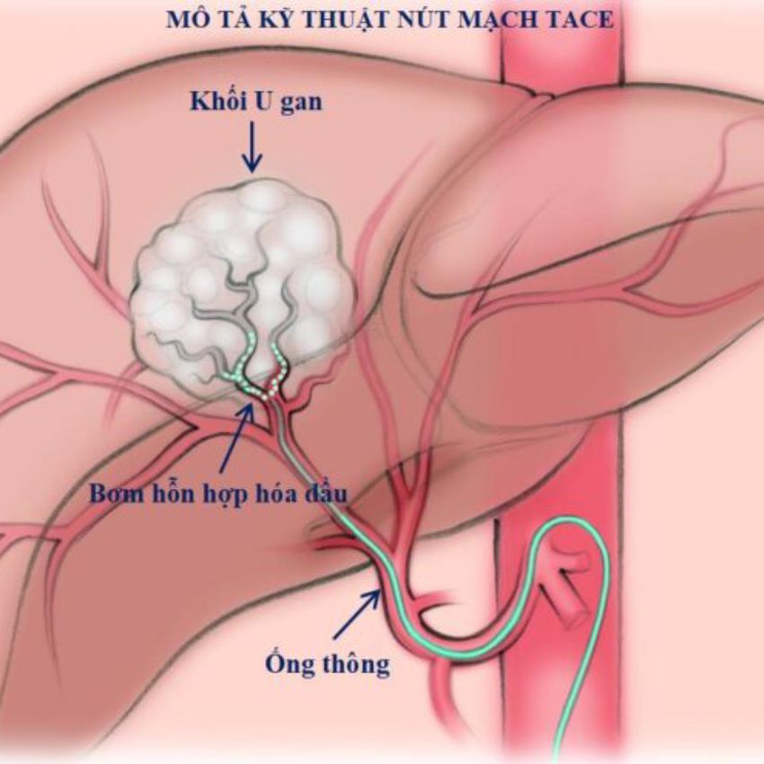 Điều trị ung thư gan bằng kỹ thuật TACE dưới hướng dẫn của máy chụp mạch số hóa xóa nền DSA